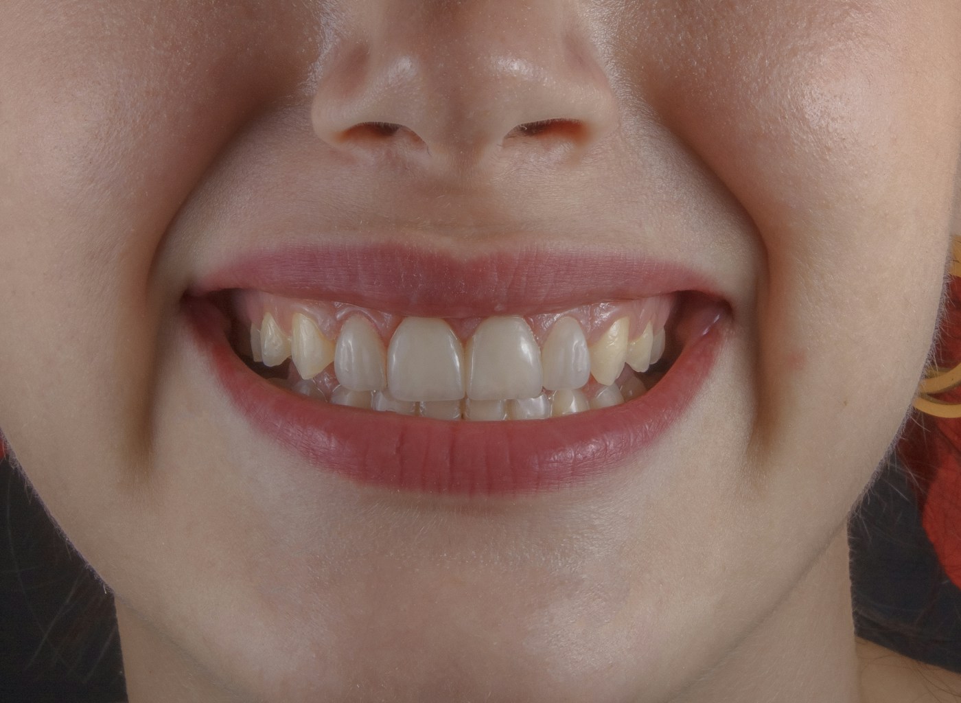 Natural-looking smile transformation achieved with composite bonding