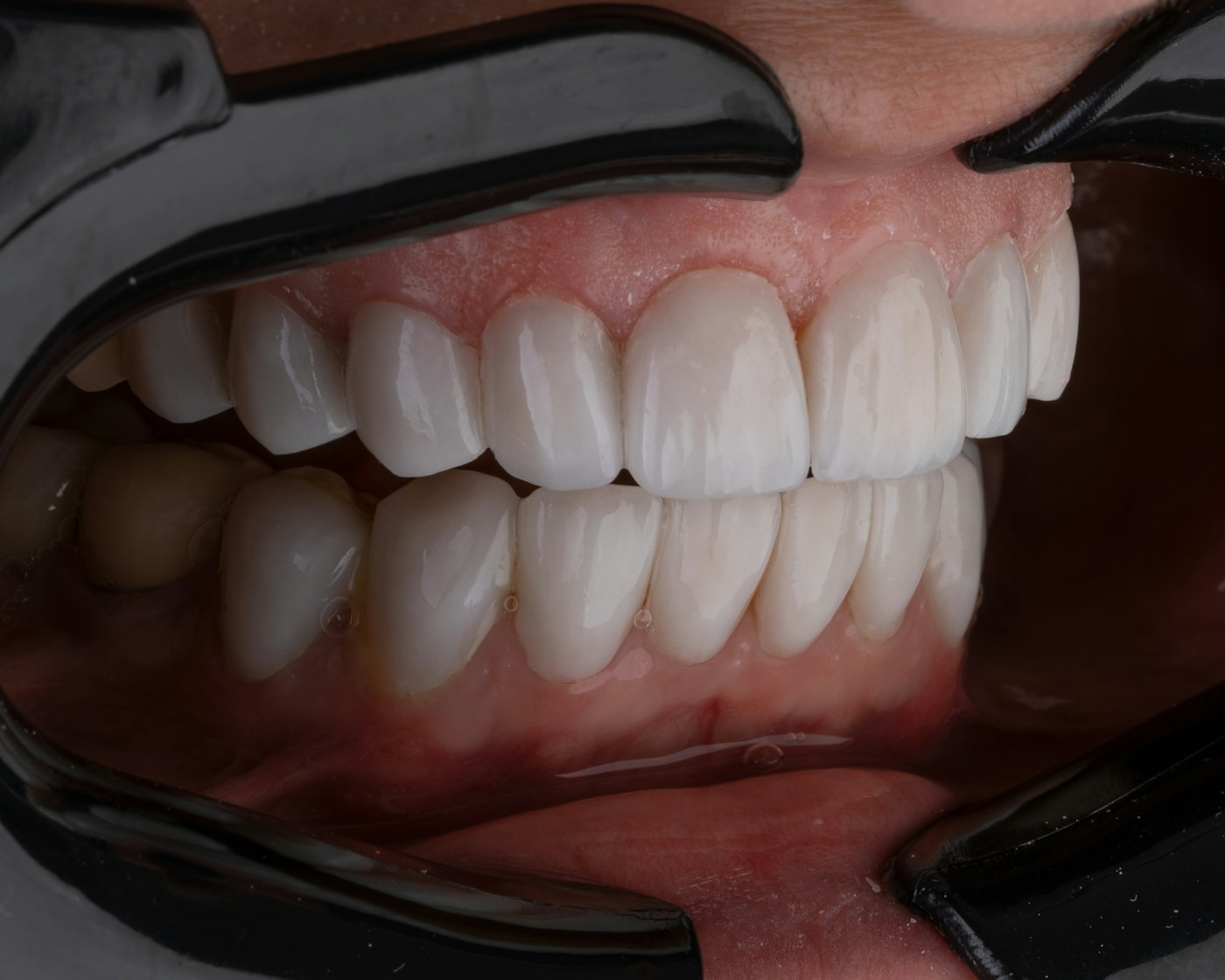 Natural smile restored with well-fitting dentures