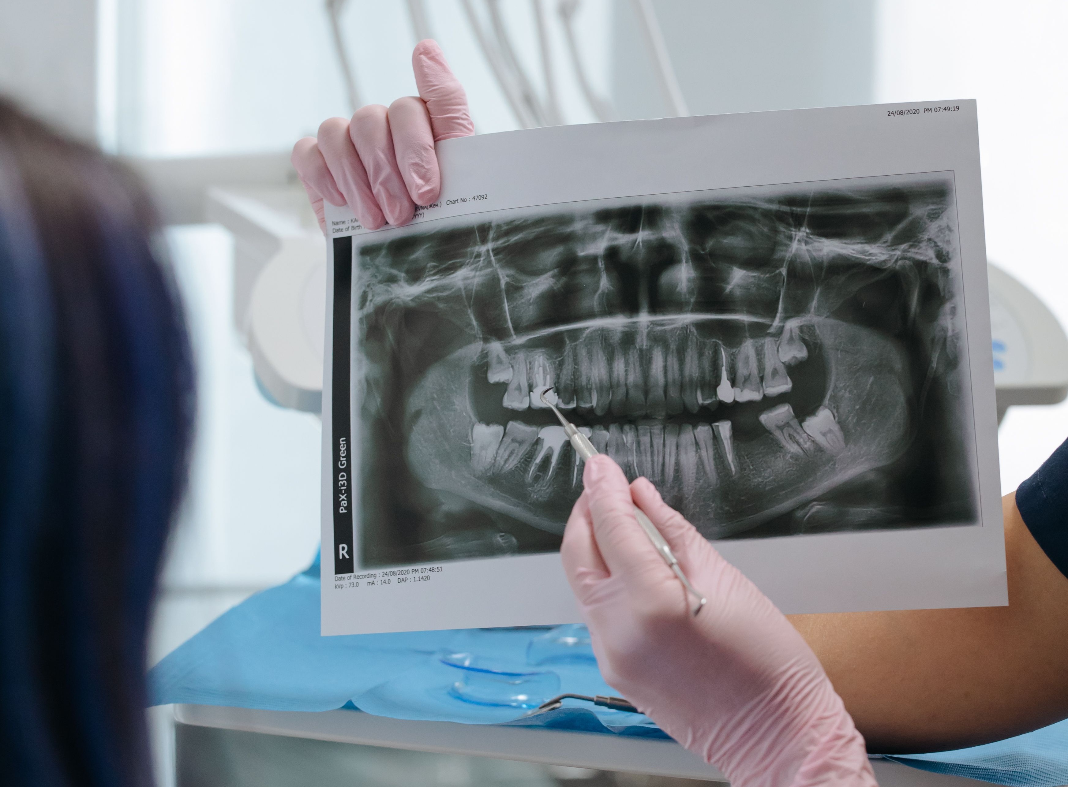 Complete, natural smile after implant treatment