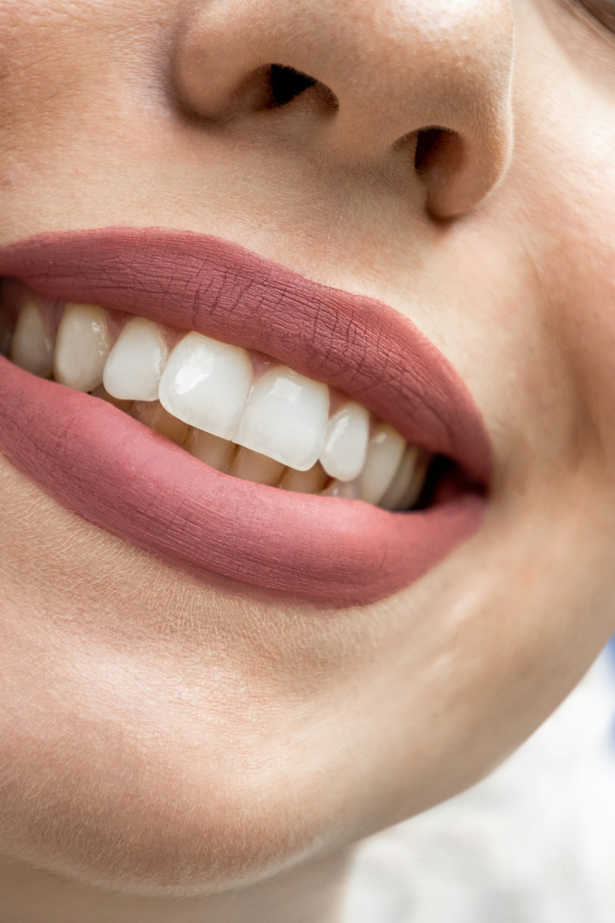 Natural, refined smile achieved with porcelain veneers