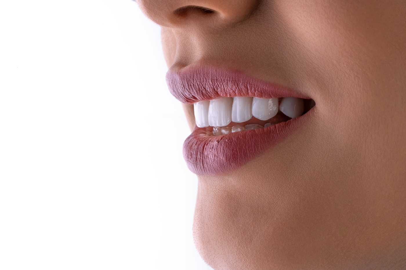 Bright, natural smile following professional teeth whitening
