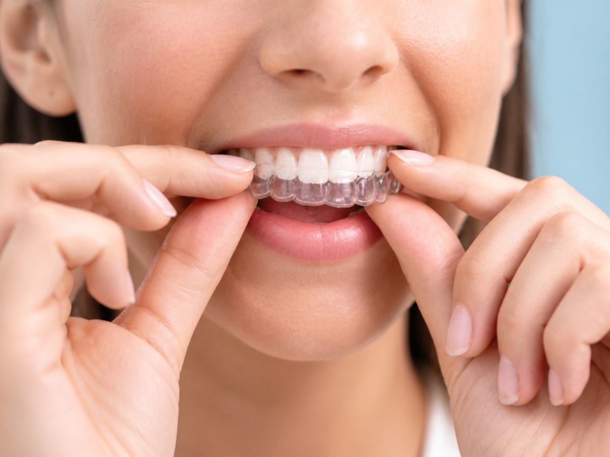 Person holding a clear dental aligner tray